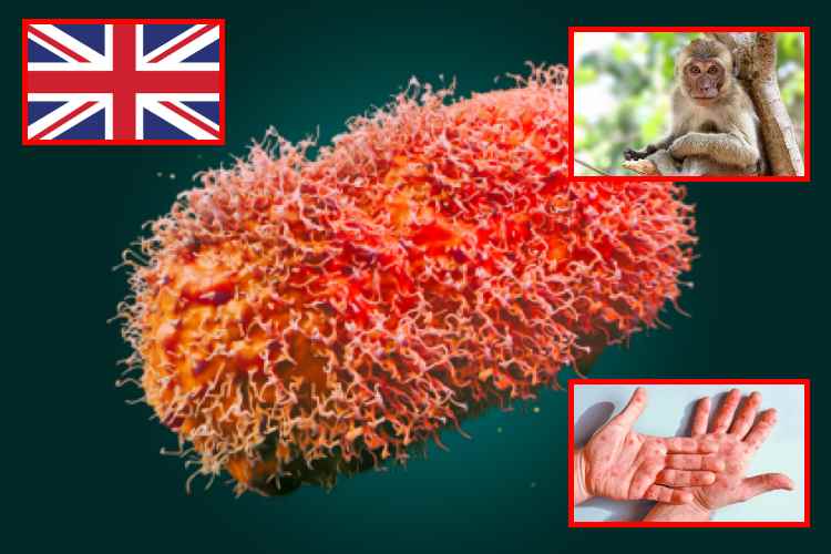 Inglaterra detecta una nueva variante de viruela del mono que combina dos cepas y despierta alertas