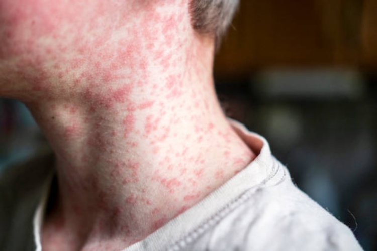 Measles viral disease, human skin covered with measles rash, vaccination concep
