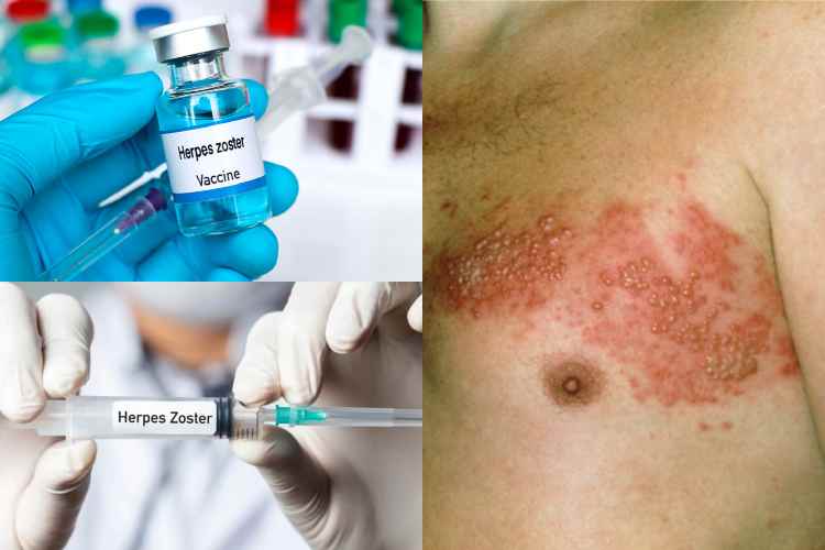 Vacuna contra el herpes zóster reduce riesgo de demencia
