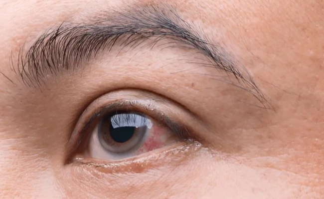 glaucoma