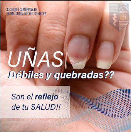 UÑAS QUEBRADISAS