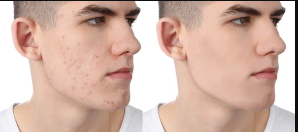 acne