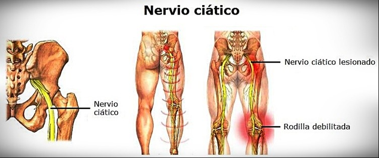 nervio ciatico